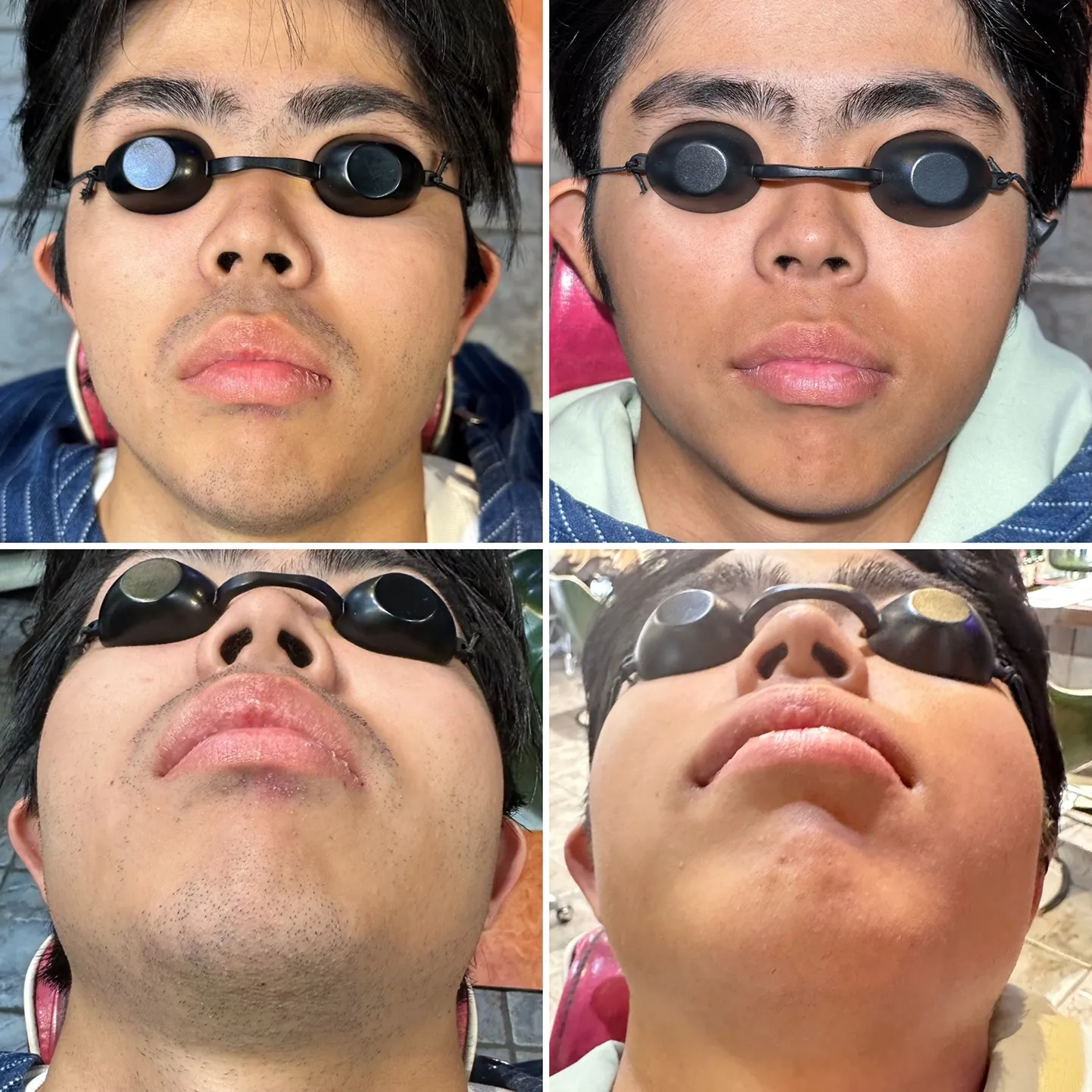 脱毛をする前とした後の写真